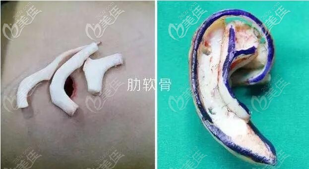 用自體肋軟骨雕刻的耳廓支架 用自體肋軟骨雕刻的耳廓支架