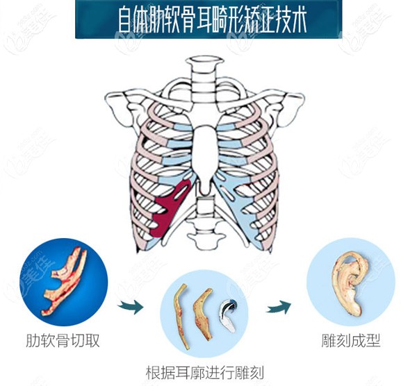 成都東籬自體肋軟骨耳畸形矯正技術(shù) 成都東籬自體肋軟骨耳畸形矯正技術(shù)