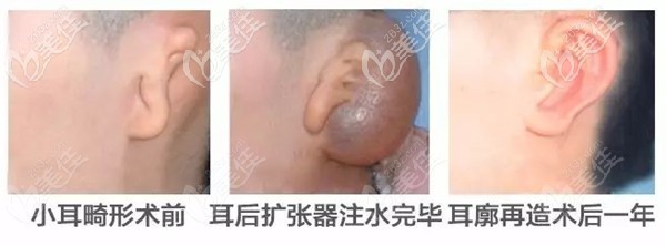 全耳再造皮膚擴(kuò)張法手術(shù)過(guò)程及術(shù)后效果 全耳再造皮膚擴(kuò)張法手術(shù)過(guò)程及術(shù)后效果