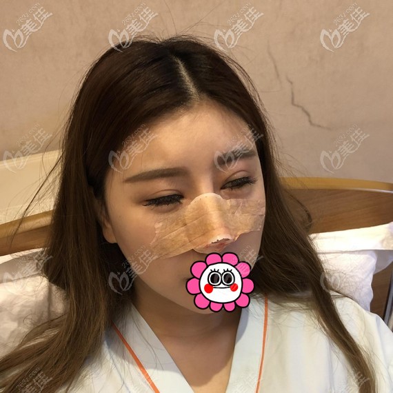 鼻修復(fù)術(shù)后即刻 鼻修復(fù)術(shù)后即刻