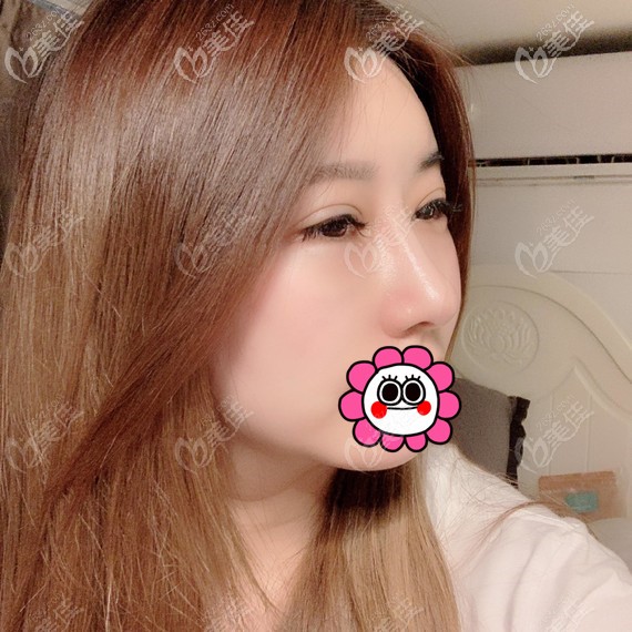 鼻修復(fù)拆線后<span style= 鼻修復(fù)拆線后<span style=