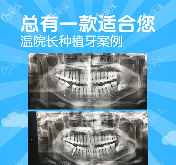 秦皇島藍(lán)天種植牙價(jià)格表