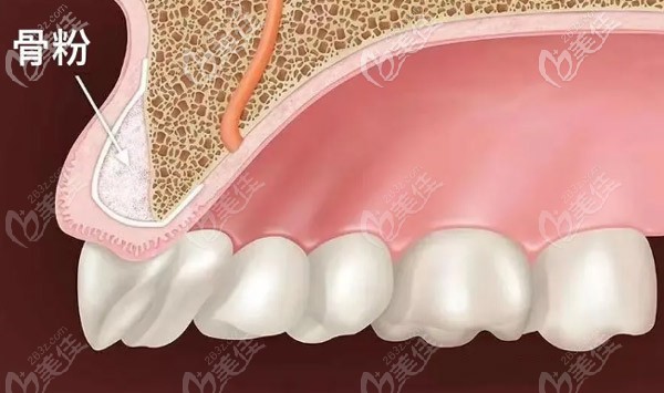 你知道哪些情況是需要植骨
