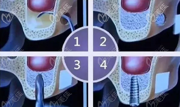 骨頭量太少，種植體長(zhǎng)不穩(wěn)