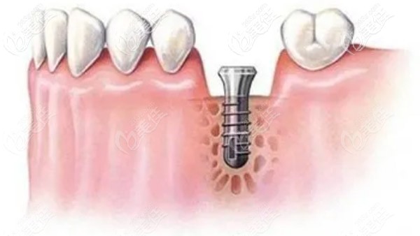 一般都會(huì)建議采取一次性植骨