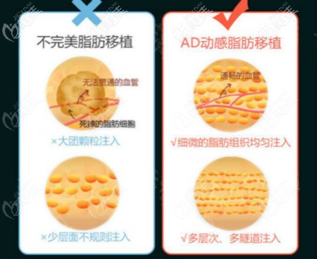 AD動(dòng)感隆胸跟自體脂肪隆胸區(qū)別 AD動(dòng)感隆胸跟自體脂肪隆胸區(qū)別
