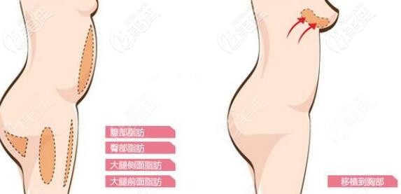 自體脂肪豐胸 自體脂肪豐胸