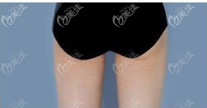 深圳福雅醫(yī)療整形美容門(mén)診部胡俊杰術(shù)前照片1