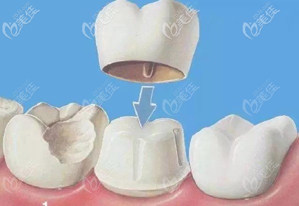 那根管后做牙冠和嵌體哪個(gè)實(shí)用性更高呢？