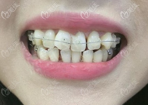 在廈門麥芽口腔做矯正前以為半隱形陶瓷牙套的效果沒有全隱形好,現(xiàn)實(shí)卻打了我的臉