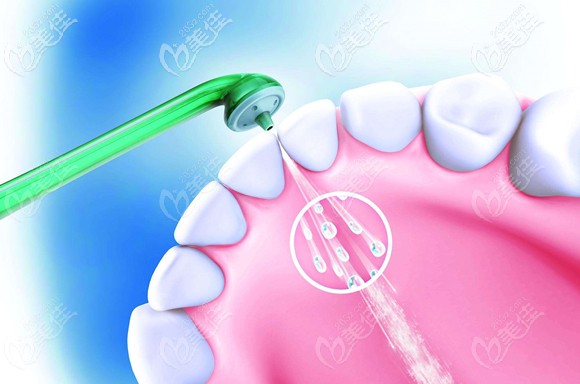 洗牙后的注意事項