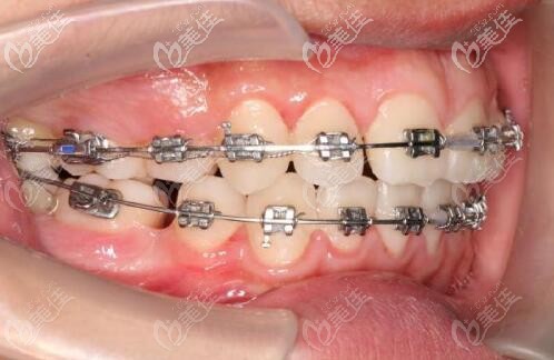 杭州美奧高思琦金屬自鎖矯正案例 杭州美奧高思琦金屬自鎖矯正案例