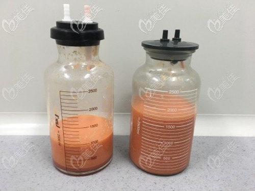 抽脂吸出來的脂肪