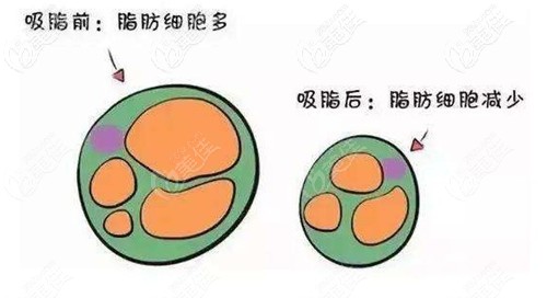 吸脂瘦的是細胞量