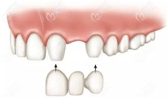 齊佳妮醫(yī)生擅長(zhǎng)多種鑲牙技術(shù) 齊佳妮醫(yī)生擅長(zhǎng)多種鑲牙技術(shù)