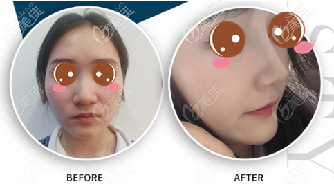 <!--<i data=20240703-sp></i>-->仁愛鼻綜合案例對(duì)比圖 <!--<i data=20240703-sp></i>-->仁愛鼻綜合案例對(duì)比圖