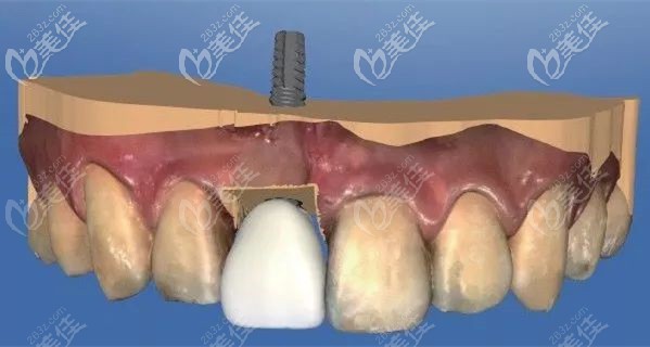 前牙美學(xué)種植示意圖 前牙美學(xué)種植示意圖