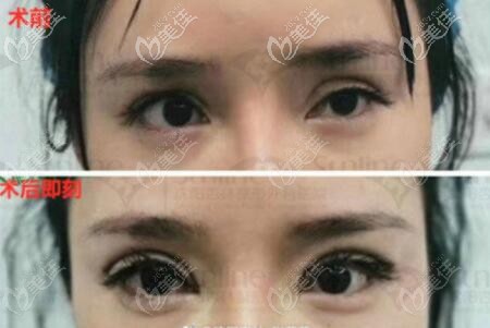 張瑩瑩雙眼皮修復(fù)真人術(shù)前術(shù)后即刻對(duì)比照 張瑩瑩雙眼皮修復(fù)真人術(shù)前術(shù)后即刻對(duì)比照