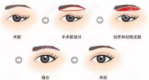 沈陽杏林王貴雄做提眉術好不好