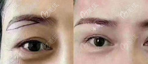 杏林王貴雄提眉術真人前后對比照