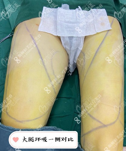 大腿環(huán)吸手術(shù)過程