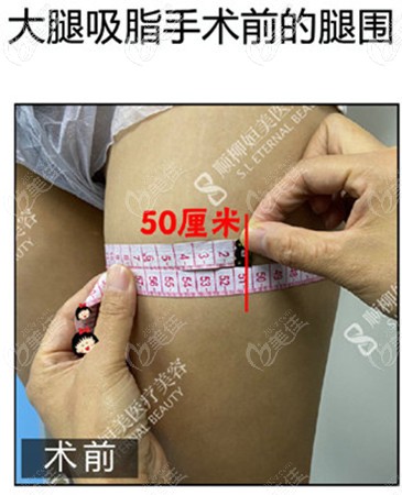 抽脂錢腿圍50厘米