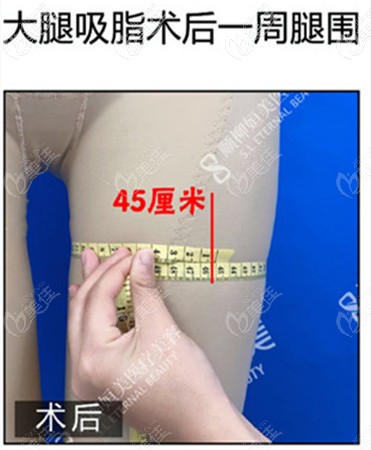 抽脂后腿圍45厘米