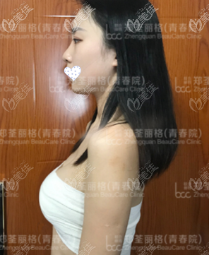 自體脂肪隆胸術(shù)后7天效果圖 自體脂肪隆胸術(shù)后7天效果圖