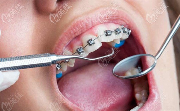 長(zhǎng)春環(huán)球口腔的牙齒矯正價(jià)格表 長(zhǎng)春環(huán)球口腔的牙齒矯正價(jià)格表