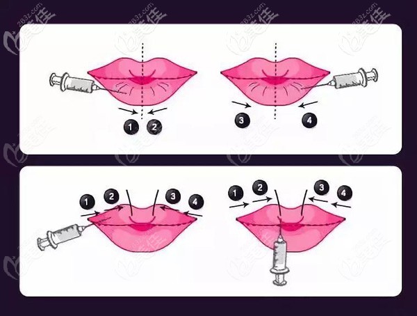 內(nèi)部資料：去合肥斯?fàn)柮雷鯩唇手術(shù)的術(shù)前術(shù)后即刻對(duì)比照，想了解的快來看