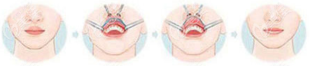 厚唇改薄手術(shù)過程示意圖