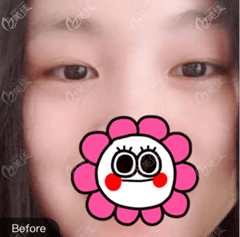 做全切雙眼皮前 做全切雙眼皮前