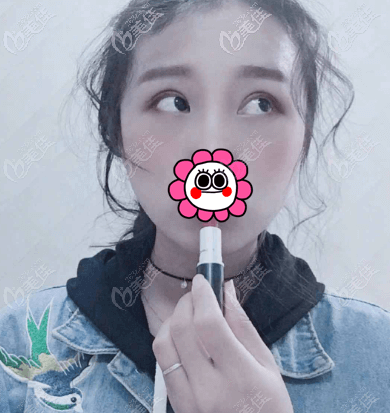 做完全切雙眼皮1個(gè)多月 做完全切雙眼皮1個(gè)多月