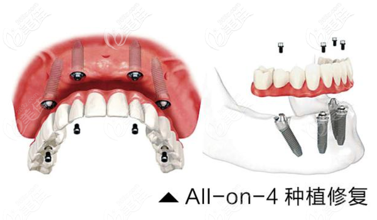 全口種植牙的費(fèi)用 全口種植牙的費(fèi)用