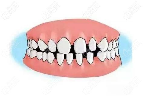 整牙，牙齒稀疏