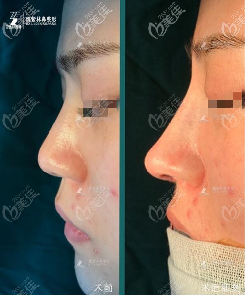 魏紫林自體肋軟骨對比案例