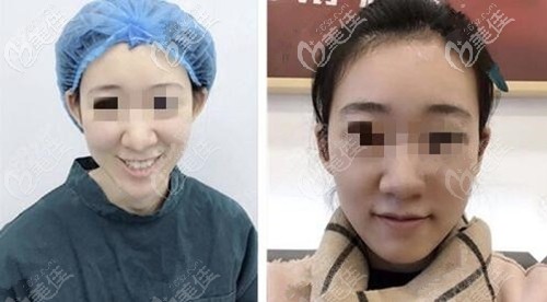 趙翊利院長招風耳矯正案例