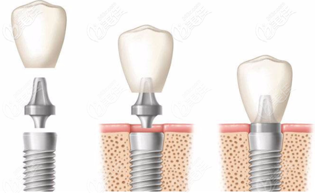 瑞士ITI種植體怎么樣