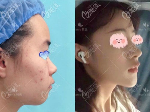 王召東鼻綜合案例