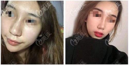 逢寶峰鼻綜合案例