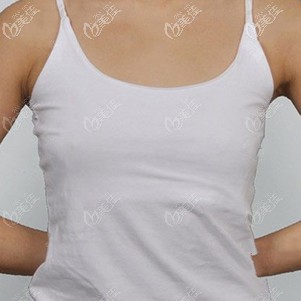 術(shù)前胸部平坦 術(shù)前胸部平坦