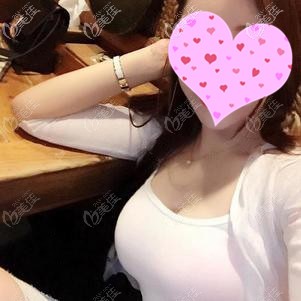 聶志宏醫(yī)生為我做假體隆胸手術(shù)效果 聶志宏醫(yī)生為我做假體隆胸手術(shù)效果