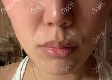 鼻基底凹陷照片