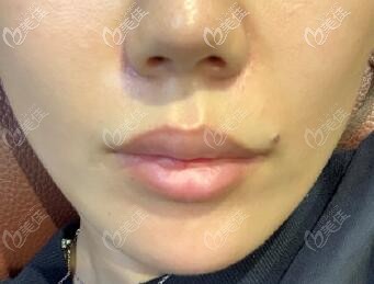 膨體墊鼻基底效果圖