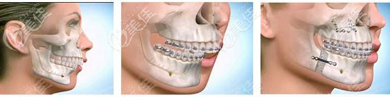 代償性正畸 代償性正畸