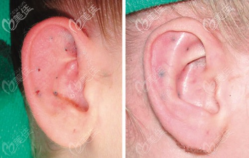 廣州高尚余文林招風(fēng)耳矯正案例