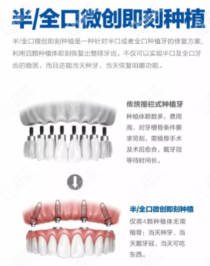 全口即刻種植優(yōu)勢