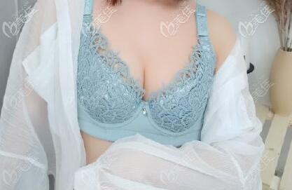 隆胸選傲諾拉璀璨330cc假體做出來有多大?胸從A罩杯到D杯的我有話說