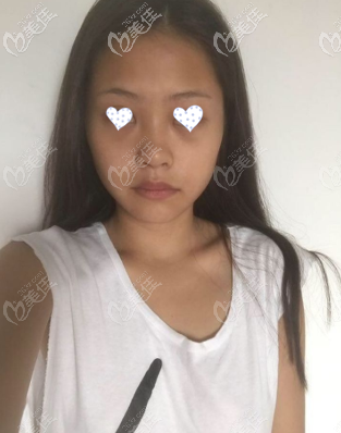 術(shù)前照 術(shù)前照