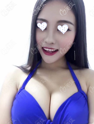 你自己看傲諾拉璀璨水滴假體250cc/290cc效果圖，胸大了3個罩杯